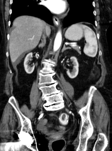 File:Galleinsteinperforation mit Duendarmnekrose - CT - coronar arteriell - 028.jpg