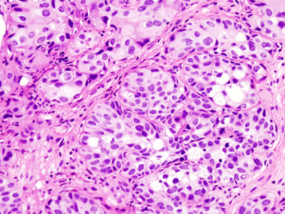 File:Bladder urothelial carcinoma histopathology (2) at trigone.jpg