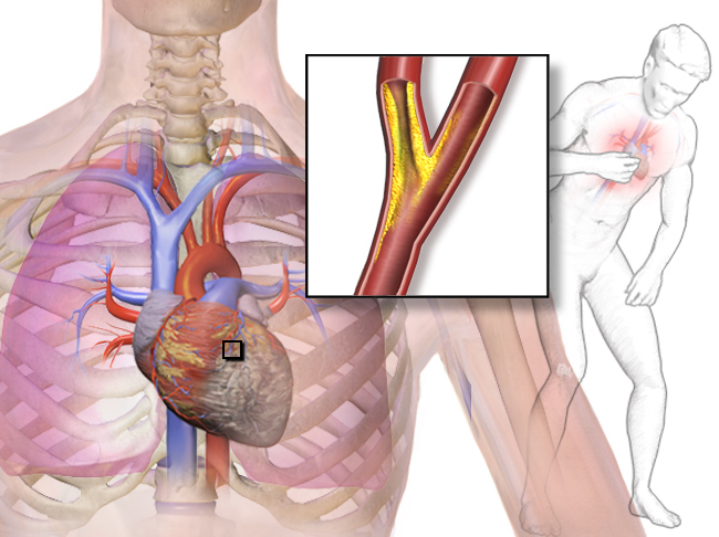 File:Blausen 0022 Angina.png