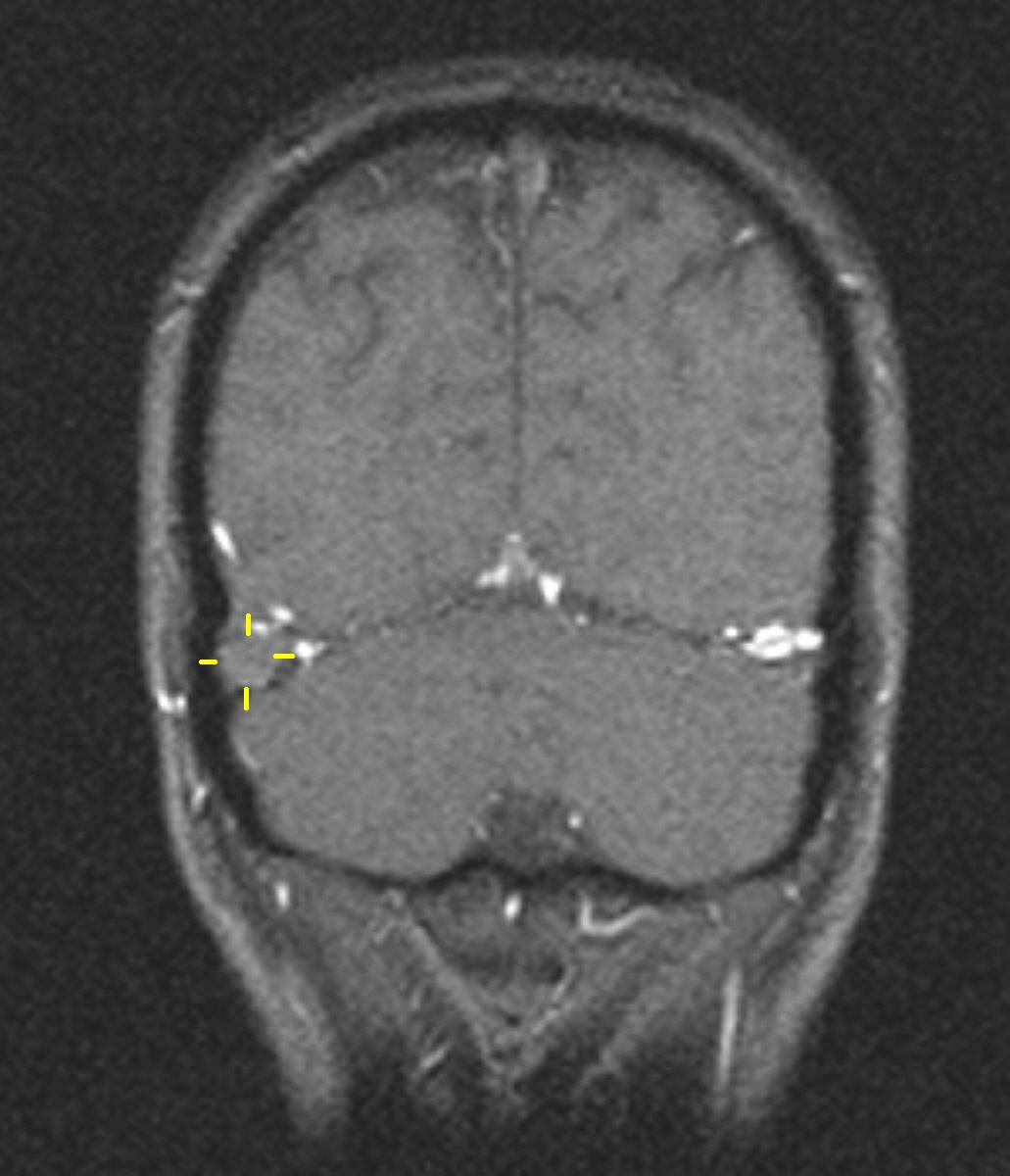 Trombosi Del Seno Venoso Cerebrale Wikipedia