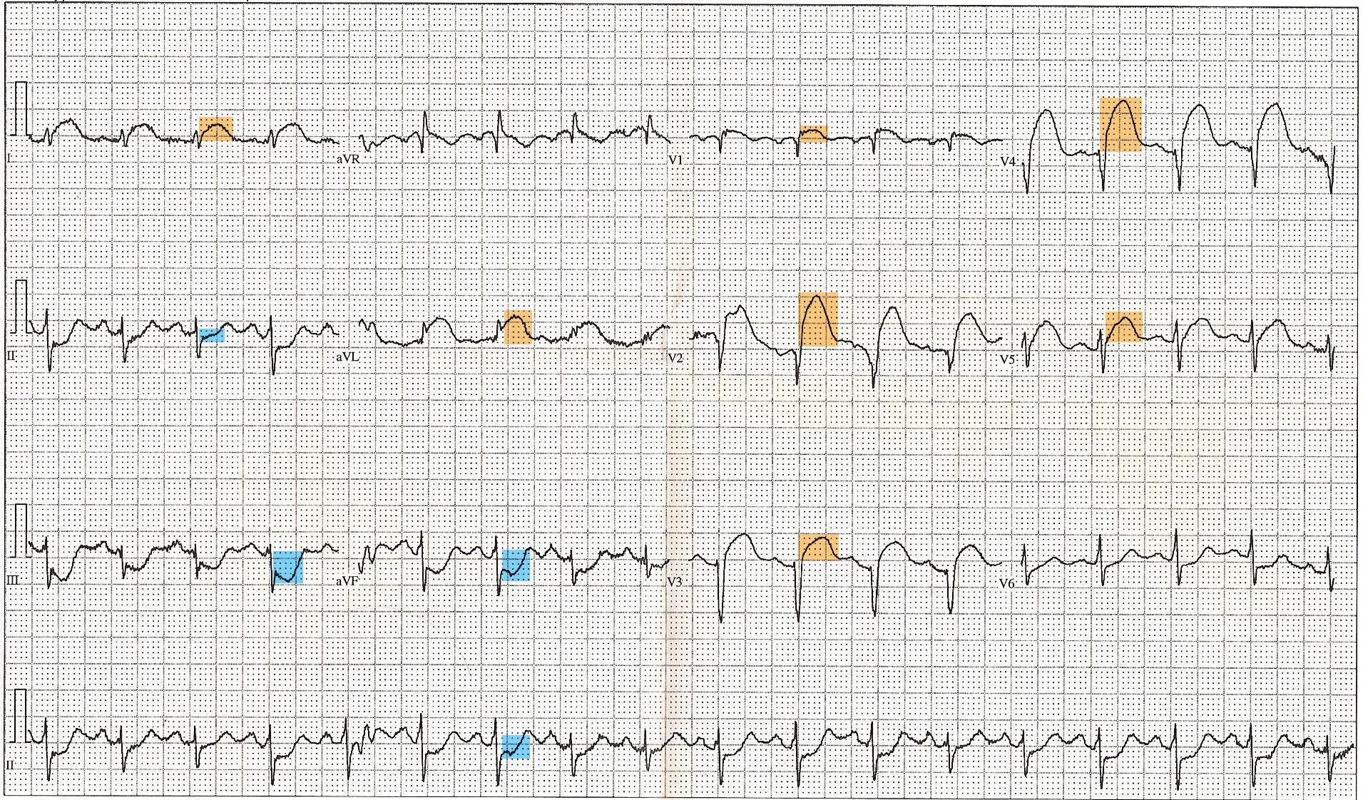 infarto anterior ecg anormal