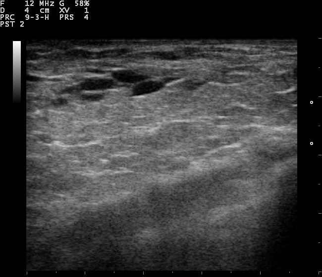 File:Breast ultrasound 110318115405 1156480.jpg