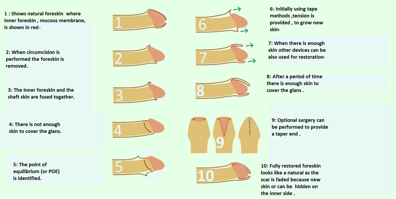 Foreskin restoration pics