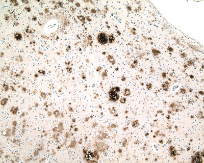 File:Proteopathy Abeta deposits in Alzheimer disease.jpg