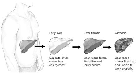 File:Stage of liver damage.JPG