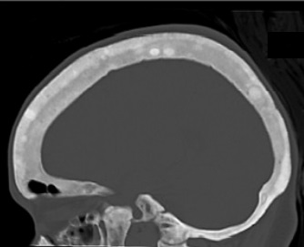 CT shows focal areas of osteosclerosis.[17]