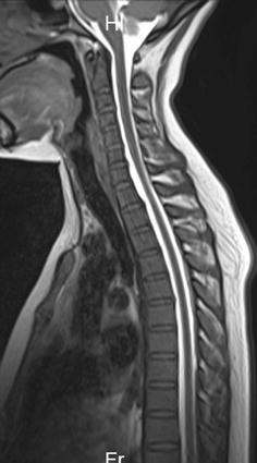 Fig3-Images-of-spinal-angiography-with-gadoterate-meglumine-at-the-level-of-3rd6th-thoracic-vertebra-conducted-7days-aft.jpg