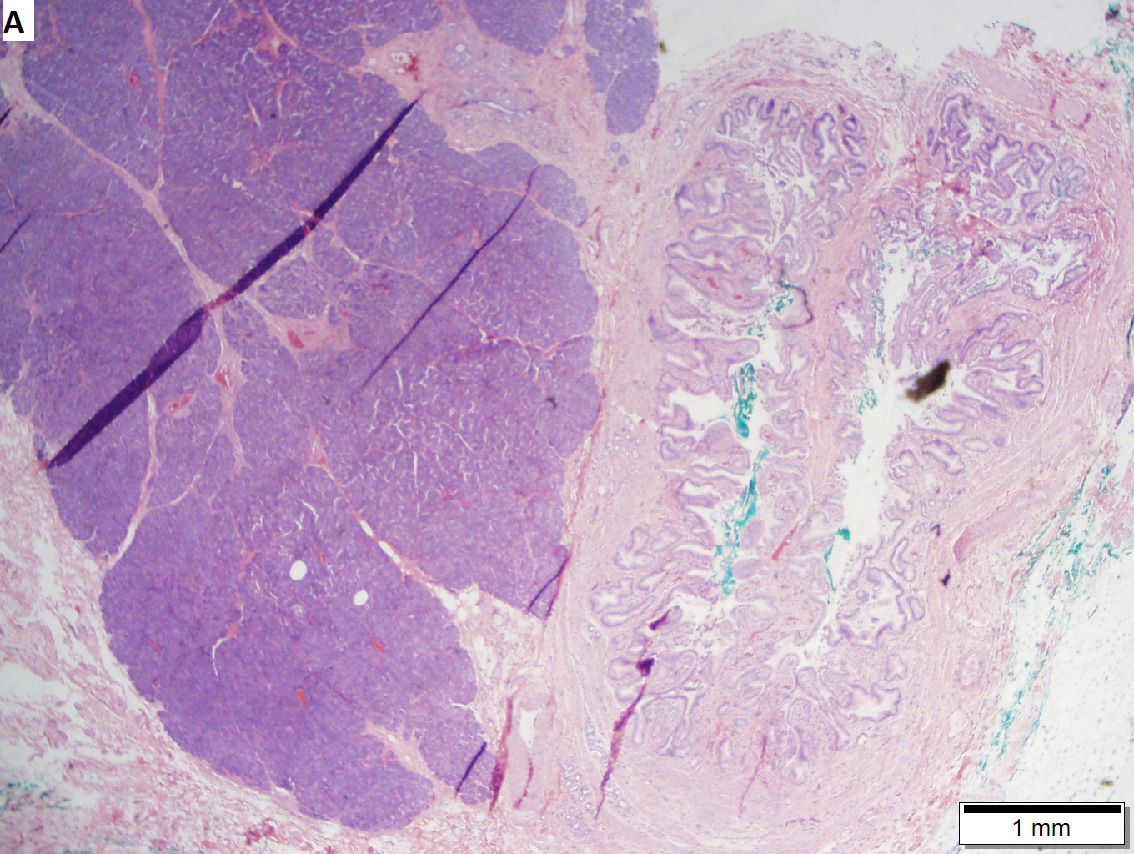 Pancreatic heterotopia in 35 year old women