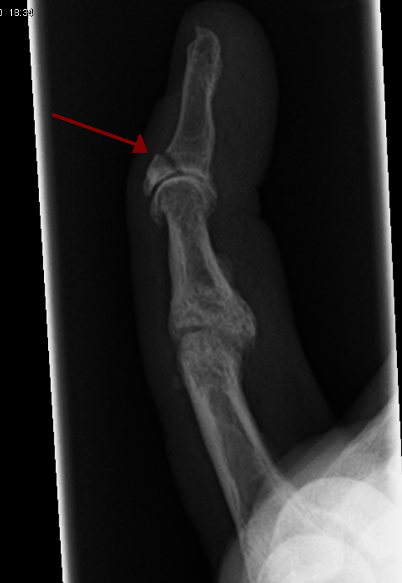 avulsion fracture finger
