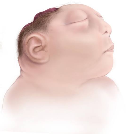 Anencephaly meaning