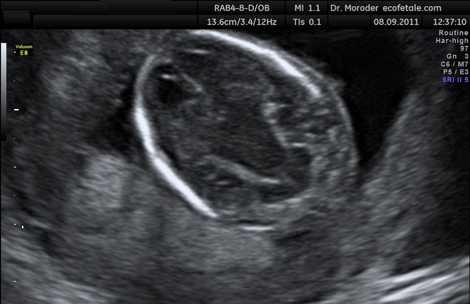 32 weeks pregnancy ultrasound vs 2 weeks old 🤍