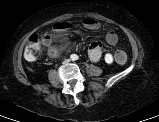 File:Galleinsteinperforation mit Duendarmnekrose - CT - axial - 028.jpg