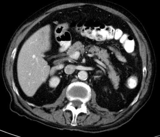 File:Hufeisenniere 07 - CT - axial - 030.jpg