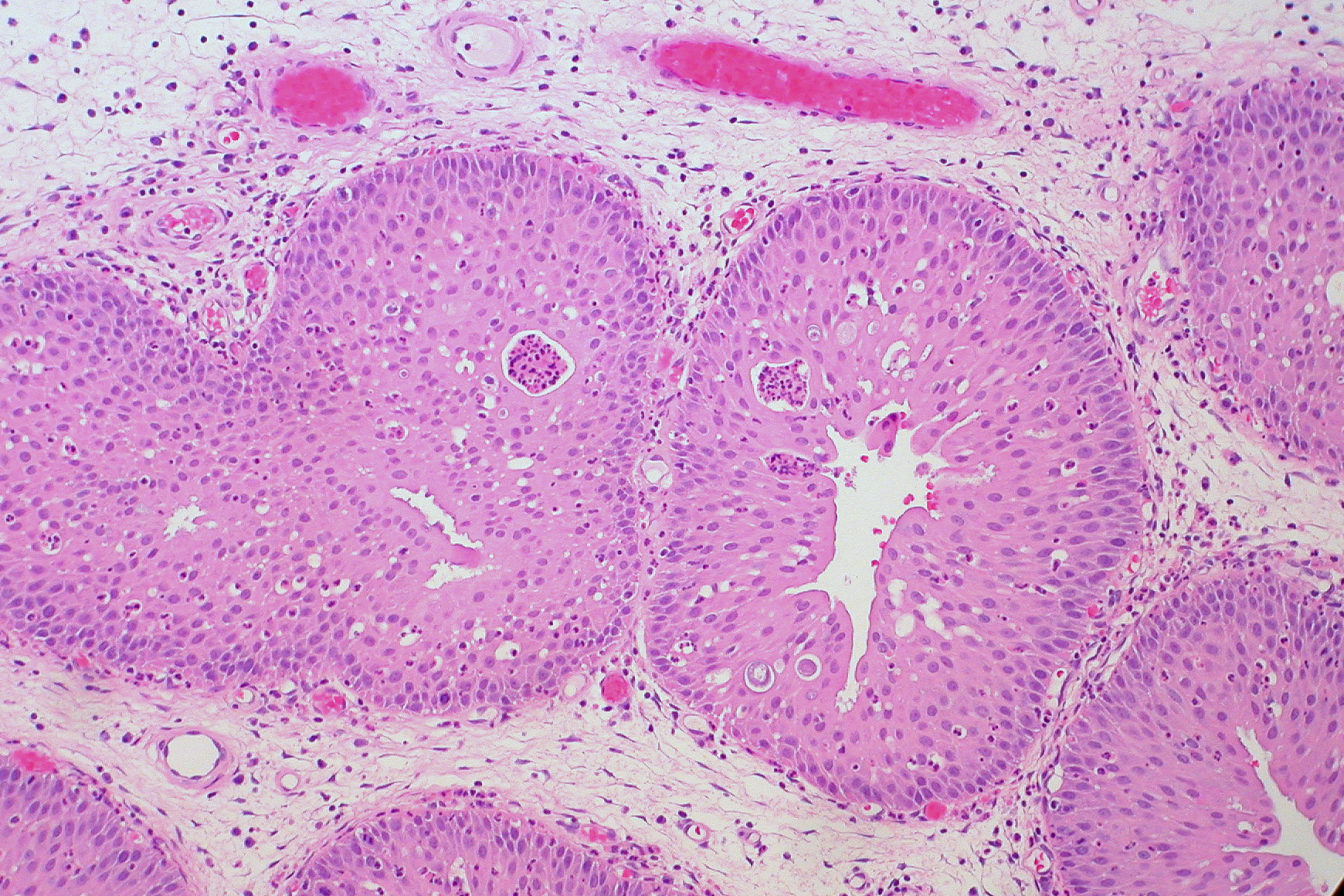 sinonasal papilloma cylindrical cell type