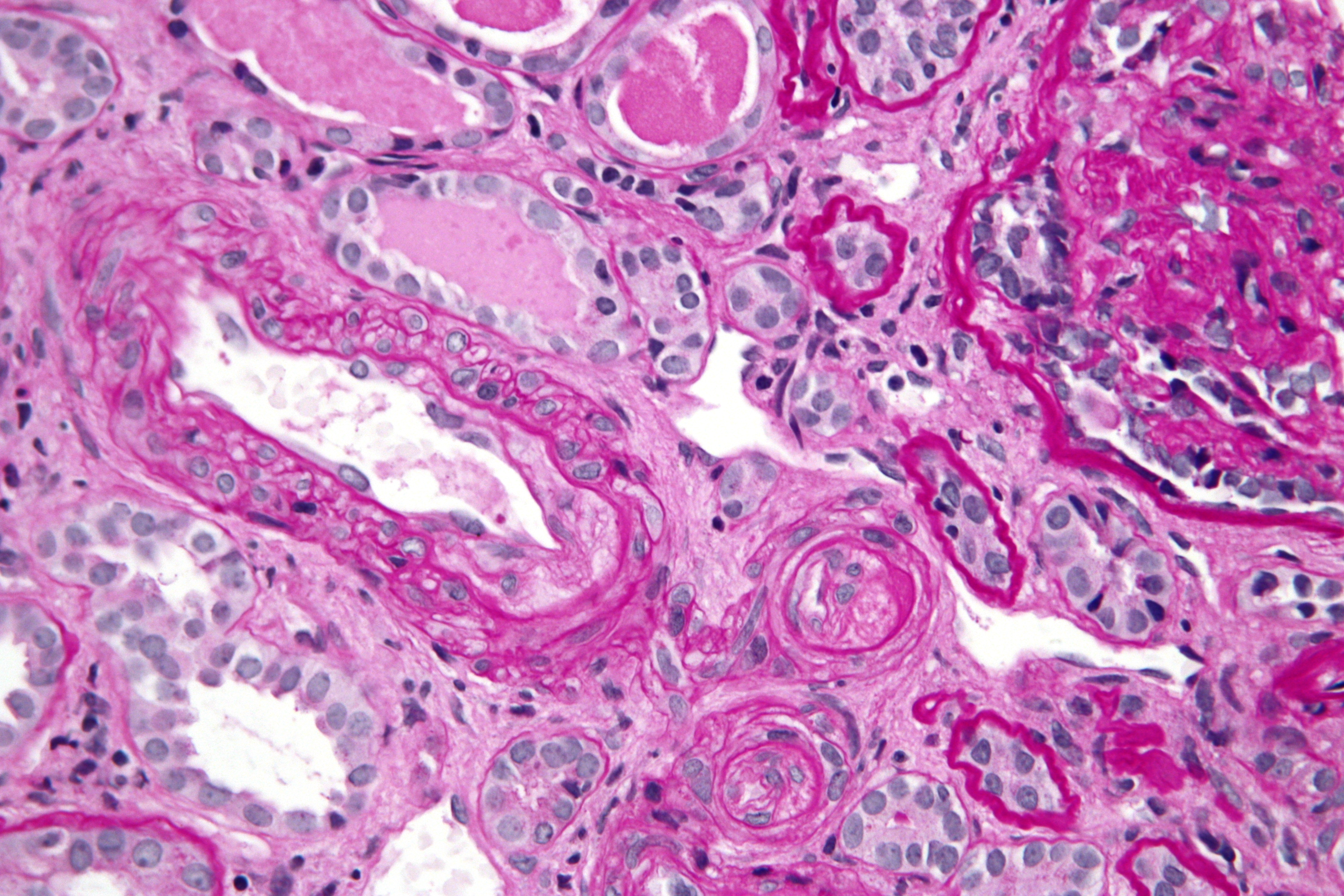 thrombotic thrombocytopenic purpura histology