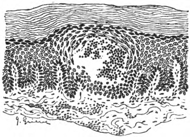 File:An introduction to dermatology (1905) Vessicle in the prickle layer.jpg