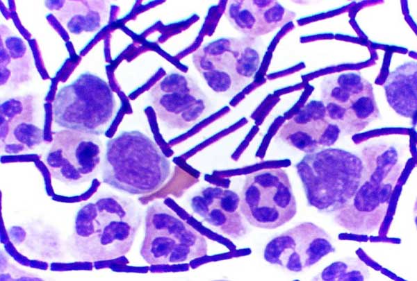 Bacillus anthracis (bâtonnets violets foncé, donc à Gram positif) se développant dans du liquide céphalo-rachidien.