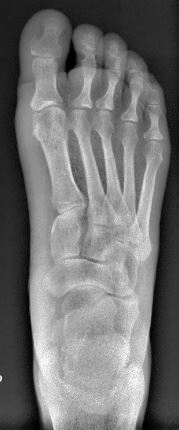 تحول مفصل إصبع القدم الكبير الأيسر في اتجاه جانبي بسبب الإفراط في التصحيح.
