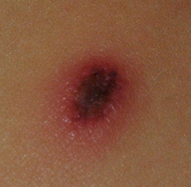File:Lesion cutánea fiebre botonosa.png