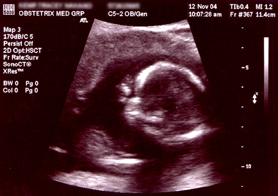 Early pregnancy dating ultrasound