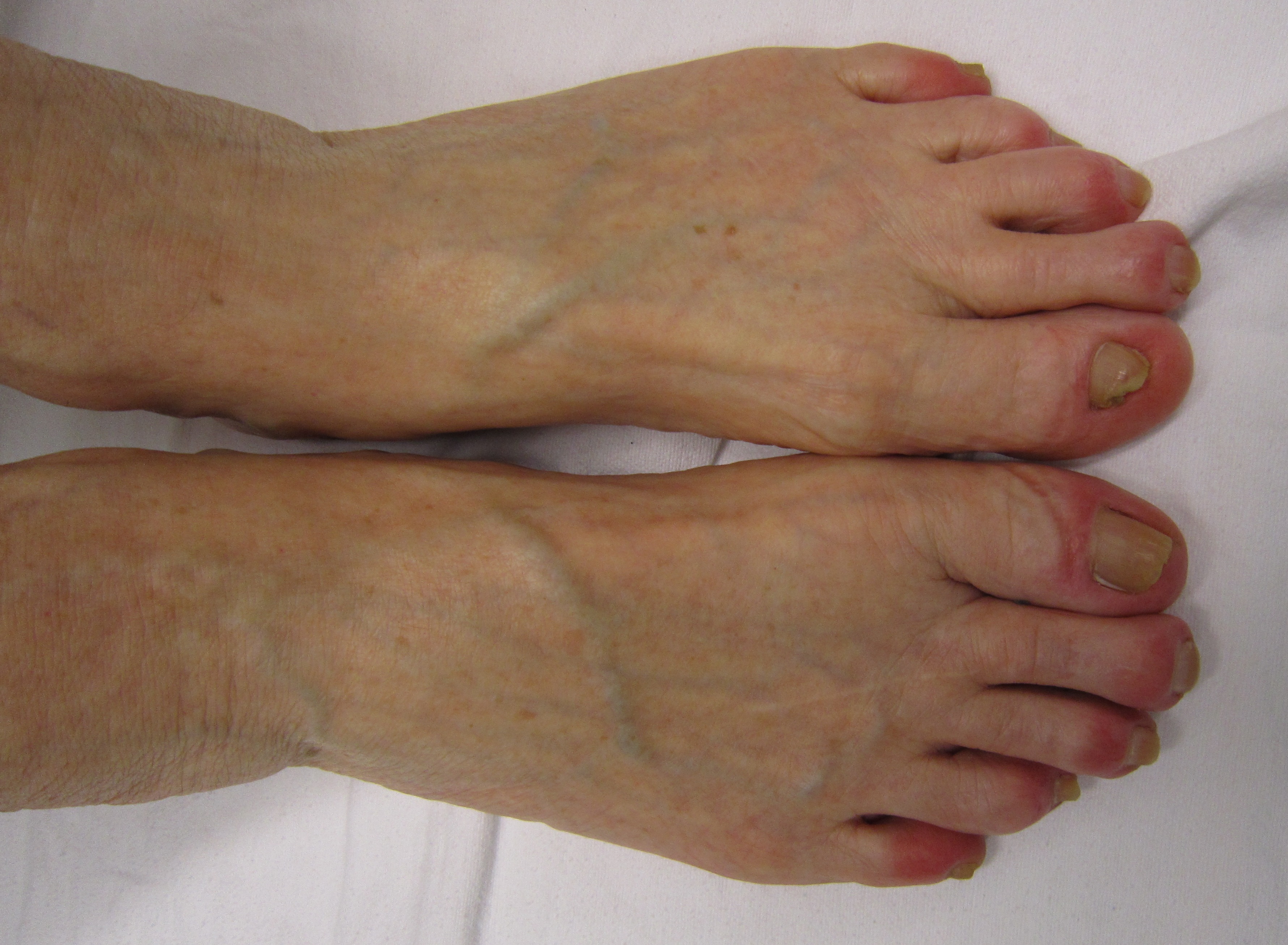 File:Chilblains from excessively icing the feet.jpg 