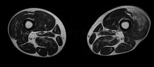 File:Myxofibrosarkom Oberschenkel - MRT - T2 axial - 008.jpg