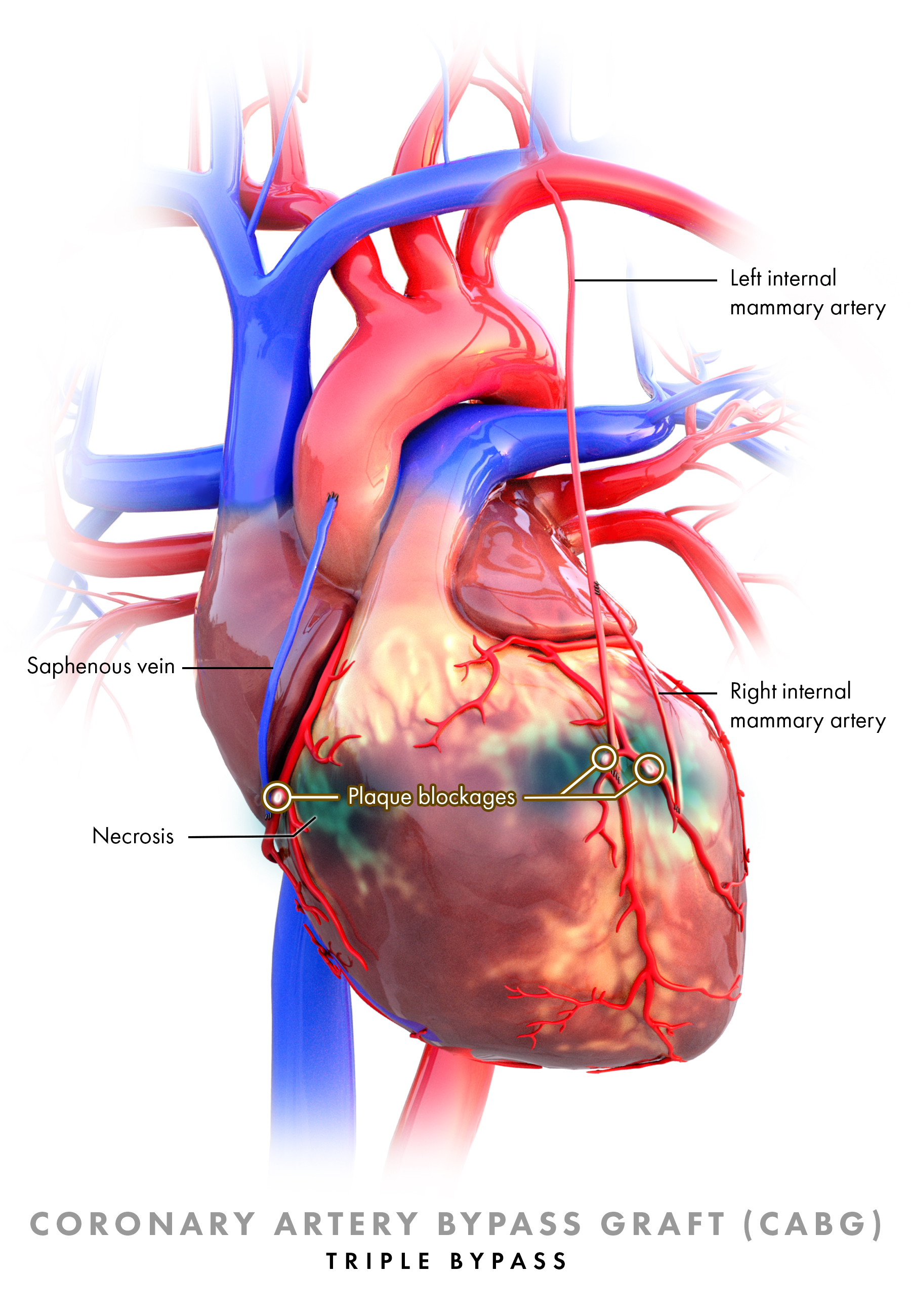 coronary artery bypass graft