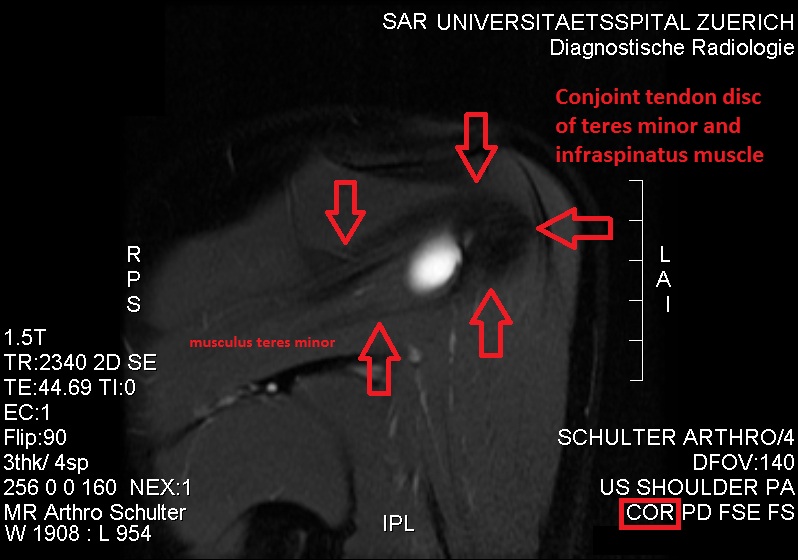 File:MRI. Conjoint and intact tendon disc of teres minor and infraspinatus muscle..jpg