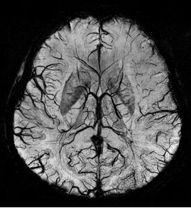 <span class="mw-page-title-main">Susceptibility weighted imaging</span>