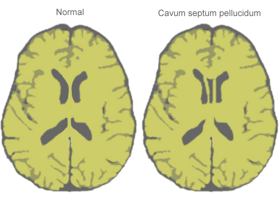 septum pellucidum and lateral ventricle