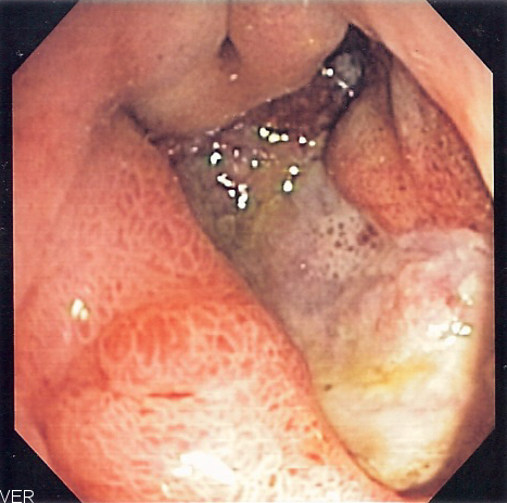 Ulcerul peptic, o afectiune de cele mai multe ori ignorata