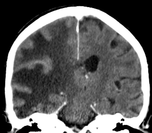 File:Keilbeinmeningeom mit Oedem - CT - coronar mit KM - 020.jpg