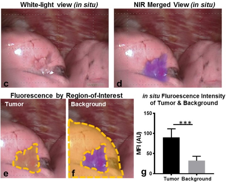 File:Squamous cell carcinoma with folate receptor alpha imaging.jpg