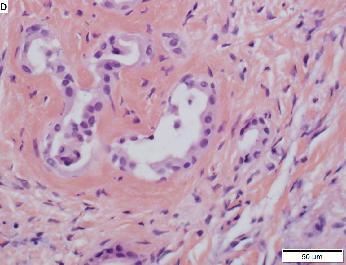 Bile duct adenoma