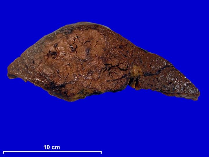 File:(UNESP-FMB DEO 20180927-09) Liver carcinoma, human.jpg