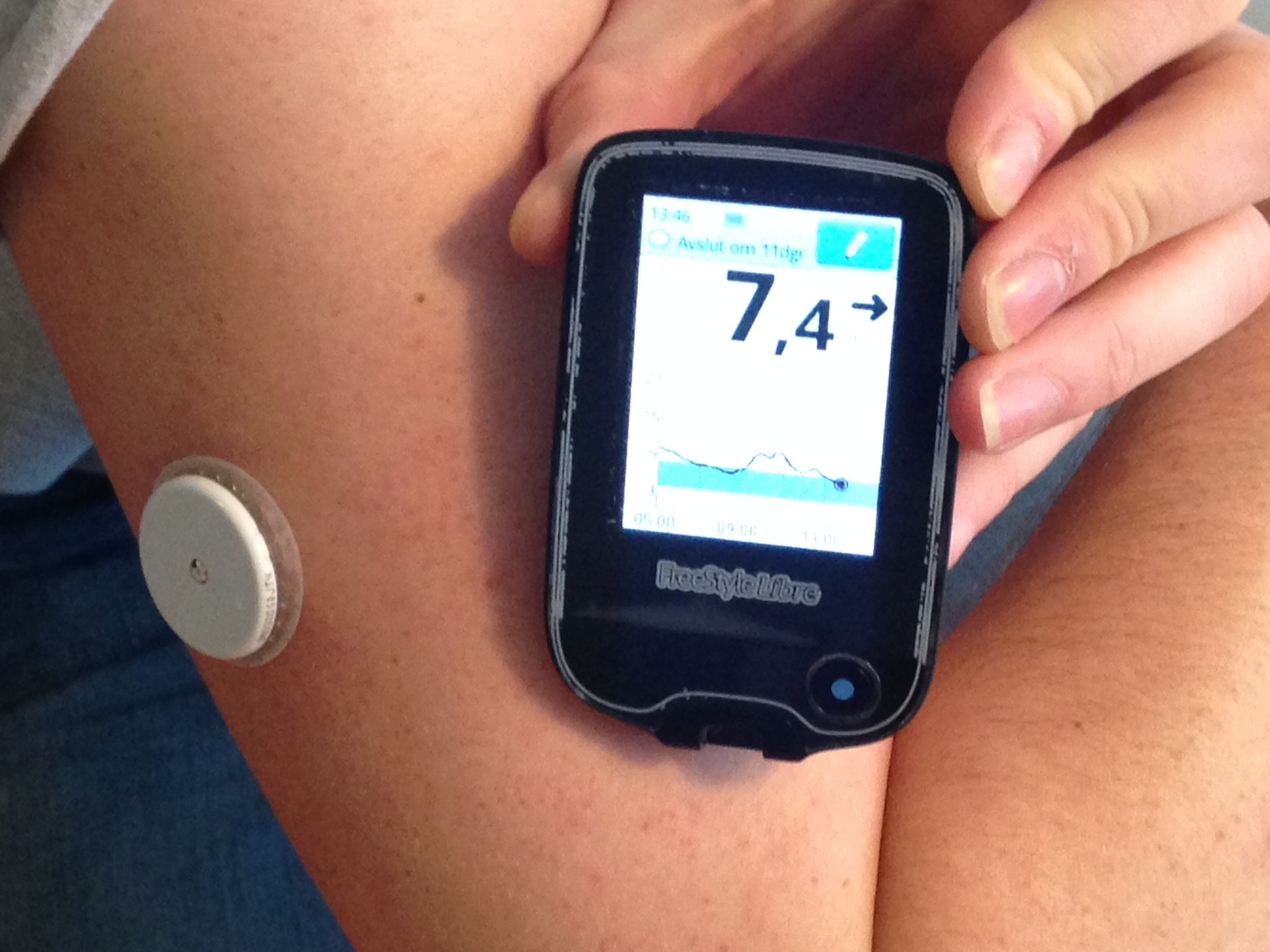 Geleend Kaliber de studie Continuous glucose monitor - Wikipedia