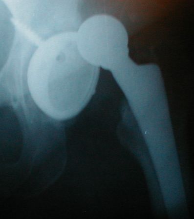 File:Posthipdislocation.jpg