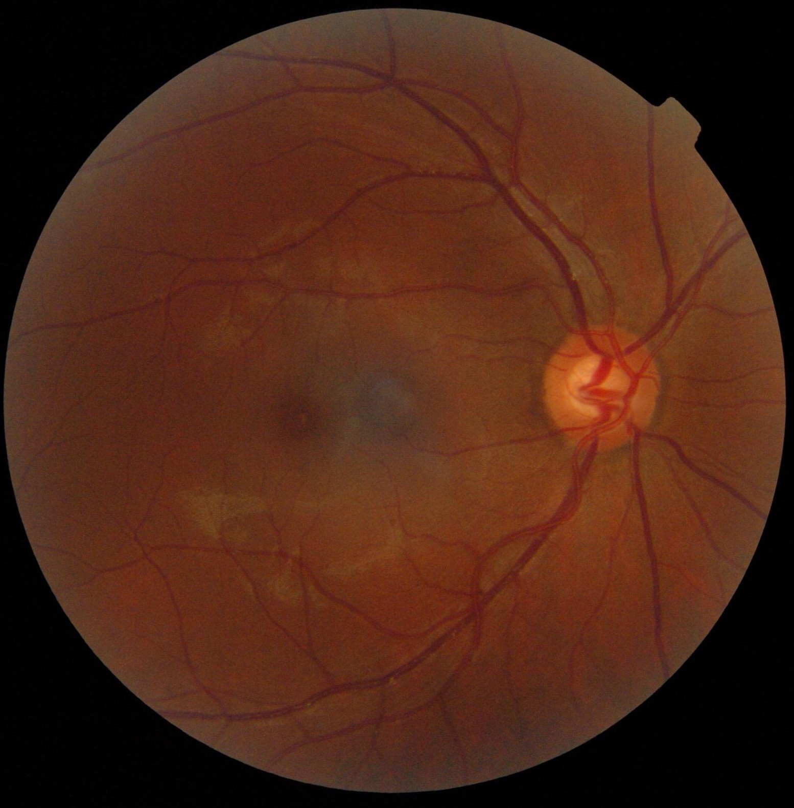 Prevención ocular Fondo de ojo