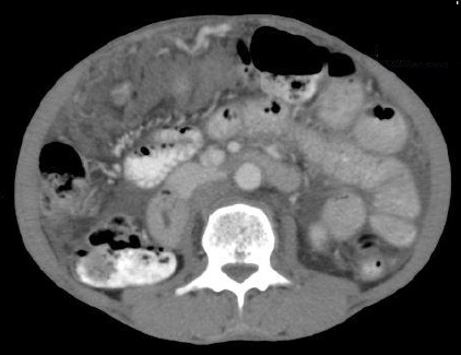 Cureus | Peritoneal Tuberculosis in Western Countries: A Rare Case With  Concurrent Helminthic Infection | Article