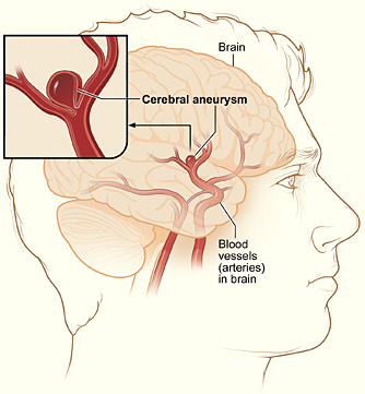 File:Cerebral aneurysm NIH.jpg