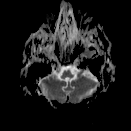 File:NPH MRI 139.png