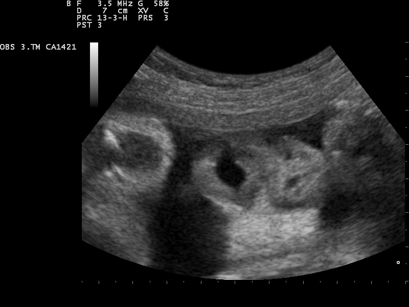 File:Ultrasound Scan ND 0119111704 1123070.png