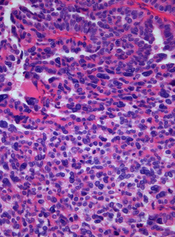 Choroidplexuscarcinoma.png