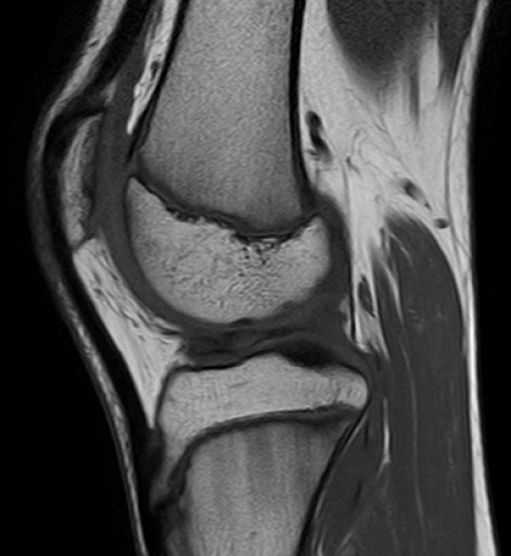 File:Korbhenkelriss Aussenmeniskus Hinterhorn - 14jm - MRT - T1 sagittal - 016.jpg