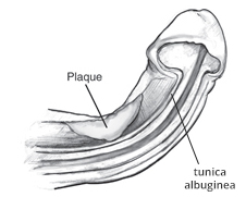 ପେରୋନି ରୋଗ: ଏହା ଏକ ପ୍ରକାର ଲିଙ୍ଗ ରୋଗ ।