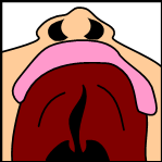 File:Cleftpalate3.png