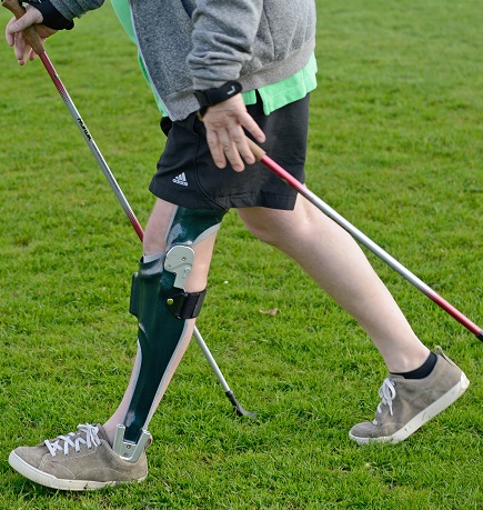 Patient after incomplete paraplegia (lesion height L3) with a knee-ankle-foot orthosis (KAFO) with an integrated stance phase control knee joint.