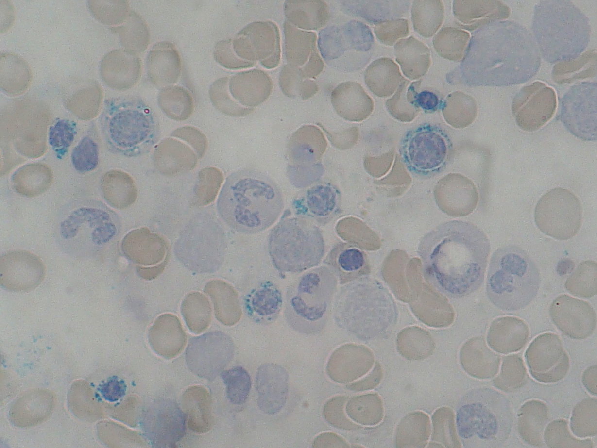 Sideroblasts stained with Perls reaction