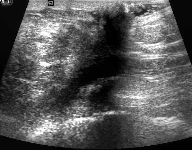 File:Breast Cancer ultrasound 15070113390.jpg