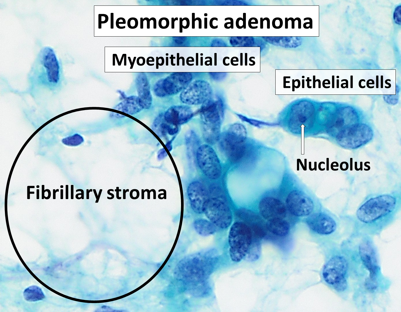 pleomorphic adenoma pathology